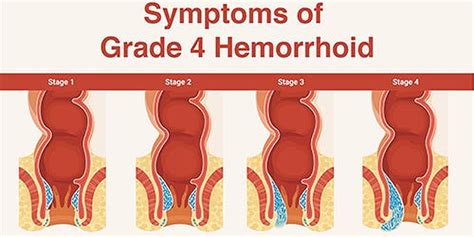 what is grade 4 hemorrhoid how to treat this piles condition