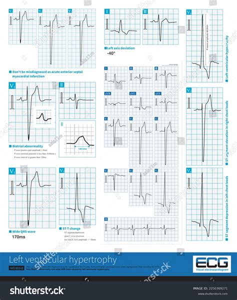 abnormal ekg images stock  vectors shutterstock