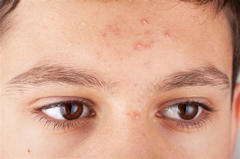 adolescent skin condition acne