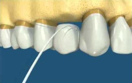 heres  awesome diagram  shows    clean  dental bridge
