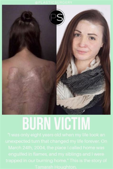 burn victim burn injury plastic surgery skin