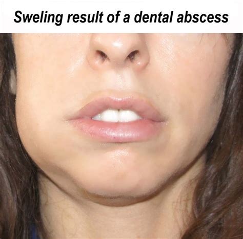 treatment   dental abscess ralev dental clinic