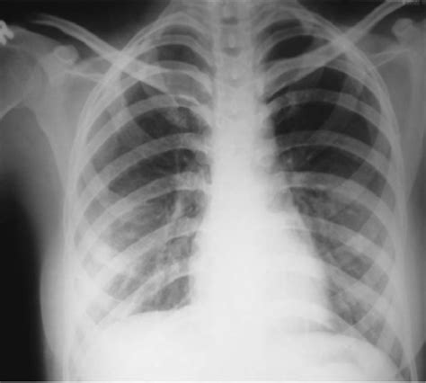 Chest X Ray Showing Bilateral First Rib Fracture With N