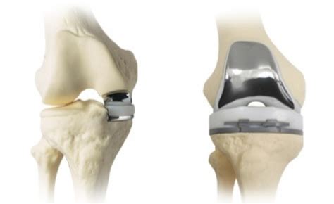 Partial Knee Replacement Surgery St George News