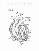 Artery Faqs Coronary sketch template