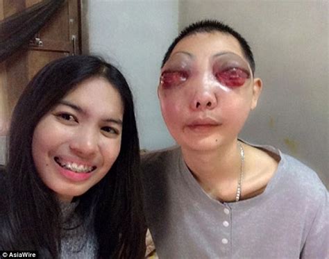 Girlfriend Stands By Her Cancer Stricken Partner After Tumor Spreads