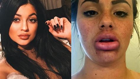 when the kylie jenner lip transformation challenge goes wrong epic fails