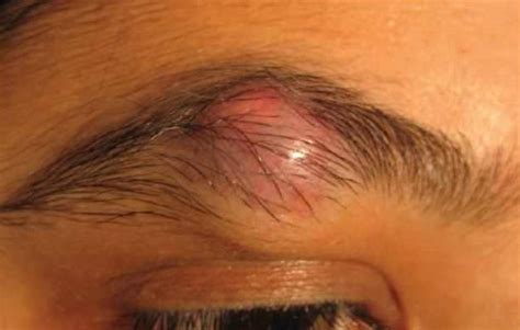 Normal Hain Vs Ingrown Hair Sumptoms Of Infection Treat N Heal
