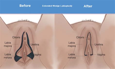 clitoral surgery before and after