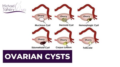 types of ovarian cysts los angeles dr michael tahery youtube
