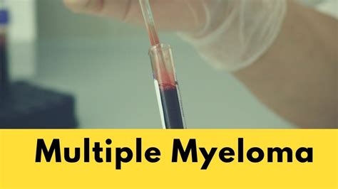 multiple myeloma bone pain  lesions youtube