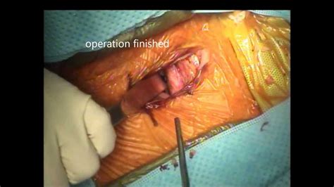 c5 cervical corpectomy with interbody cage youtube