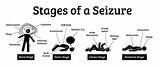 Seizure Seizures Epilepsy Symptoms Stages Main Types sketch template