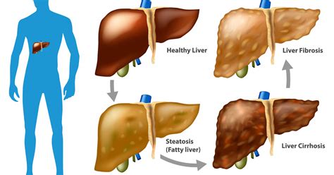 fatty liver disease hep