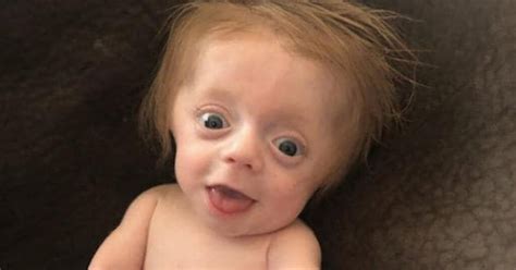 Newborn Diagnosed With Brittle Bone Disease Defies All Odds – Inner