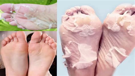 how to get rid of peeling skin on your feet youtube
