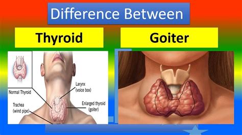 goiter  thyroid deanne stageman