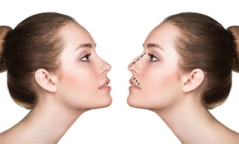 aquiline nose surgery nose shape surgery  korea rhinoplasty nose surgery perfect nose