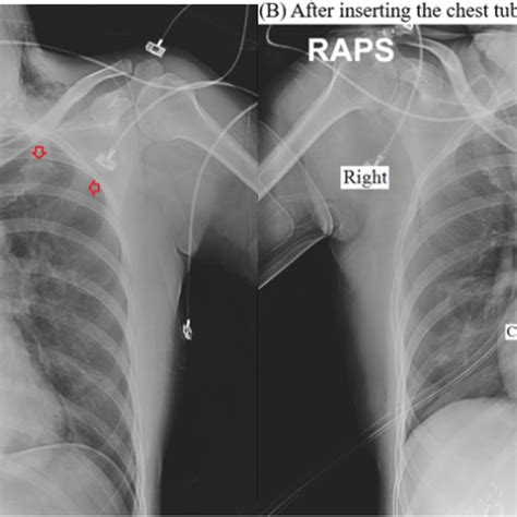 Chest Radiography A Before Inserting The Chest Tube B After Inserting