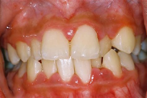 periodontics gum treatment dentist  puchong