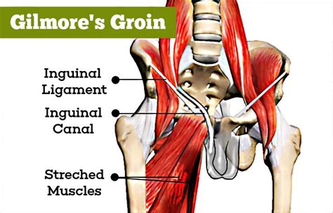 groin muscles diagram anatomy  groin  adductors gilmores groin