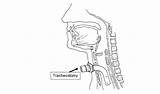 Tracheostomy Airway sketch template