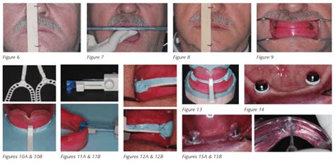 oral appliance therapy for the edentulous pap intolerant