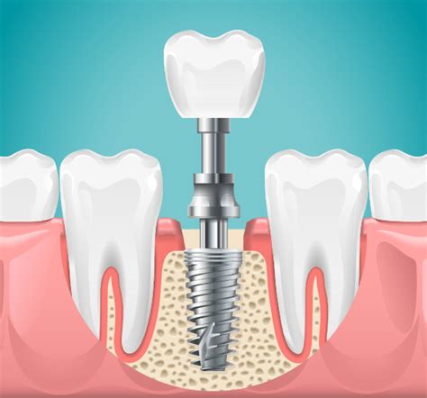 advantages  disadvantages  zirconia dental implants
