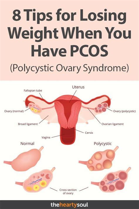 pin on pcos weight loss
