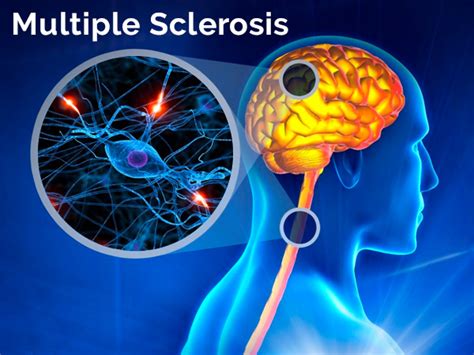 multiple sclerosis  symptoms diagnosis  treatment boldskycom