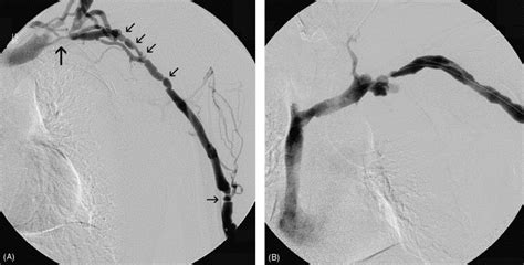 central venous stenosis in haemodialysis patients without a previous