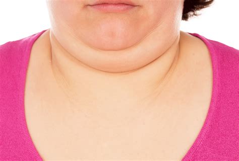 rid   double chin exercise diet treatment