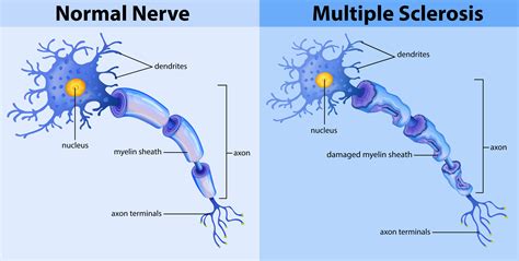 normal nerve  multiple sclerosis  vector art  vecteezy