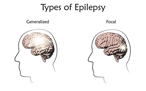 epilepsy types