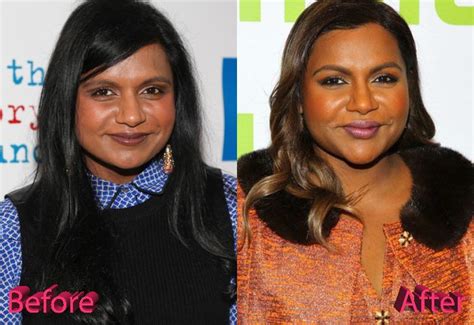 mindy kaling    cosmetic surgery cosmetic surgery