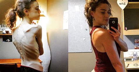 Duras Imágenes Del Antes Y Después De Una Sobreviviente De Anorexia