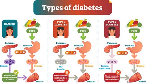 types  diabetes health  human services north dakota