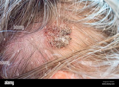 seborrheic keratoses benign skin tumor on a male scalp with a bumpy