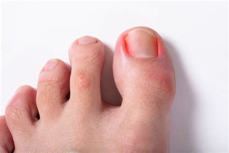 ingrown toenail treatment service feet  podiatry waikato