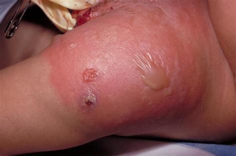 mrsa infection pictures causes symptoms treatment prevention diseases pictures