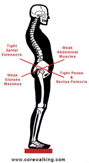 Lower Crossed Syndrome