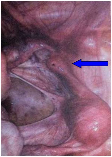 Pregnancy In A Unicornuate Uterus A Case Report Journal Of Medical