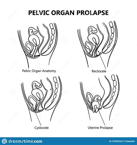 Pelvic Organ Prolapse Variously Monochrome Education Vector Set Stock