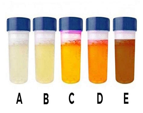 blut im urin urin farbe moegliche ursachen behandlung