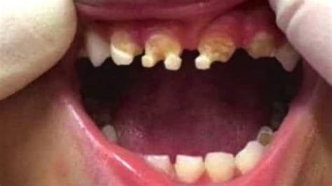 cet enfant se retrouve avec les dents ravagées par une substance bien