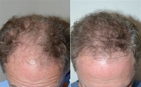 Hair Transplants For Men Pictures Miami Fl Paciente 108657