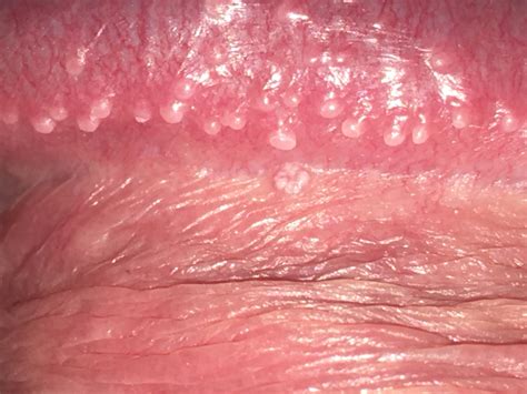 got any idea what this might be penis disorders forums patient