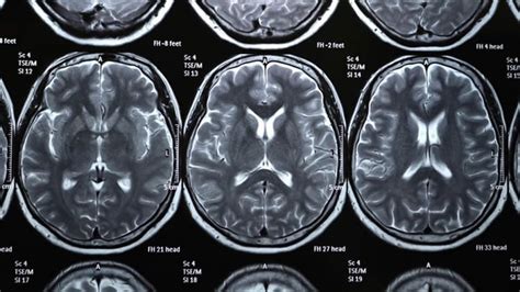concussion may increase parkinson s risk neuroscience news