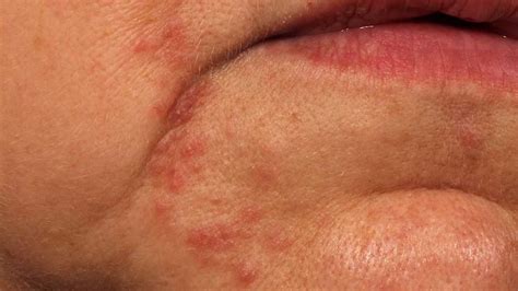 dry skin around the mouth causes and treatments