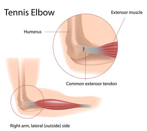 tennis elbow definition anatomy   jeffrey  berg md
